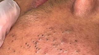 Korean Skincare Routine – THE ULTIMATE GUIDE | Deep Cleansing & Blackhead Removal